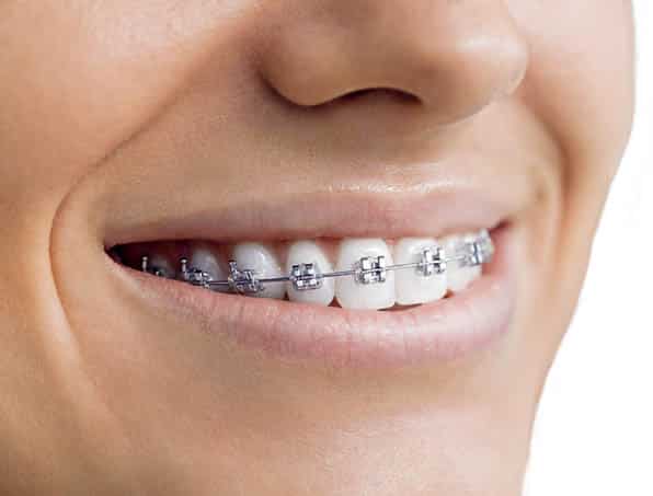Metal braces on close-up smile.