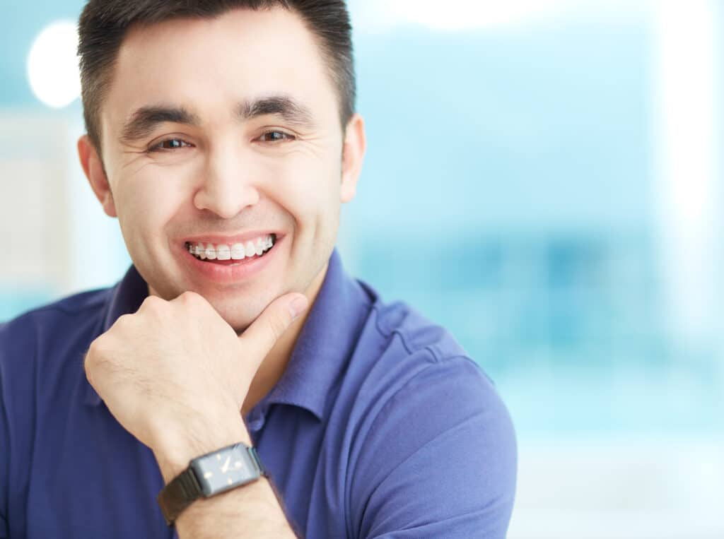 Man smiling with clear braces on his upper teeth.
