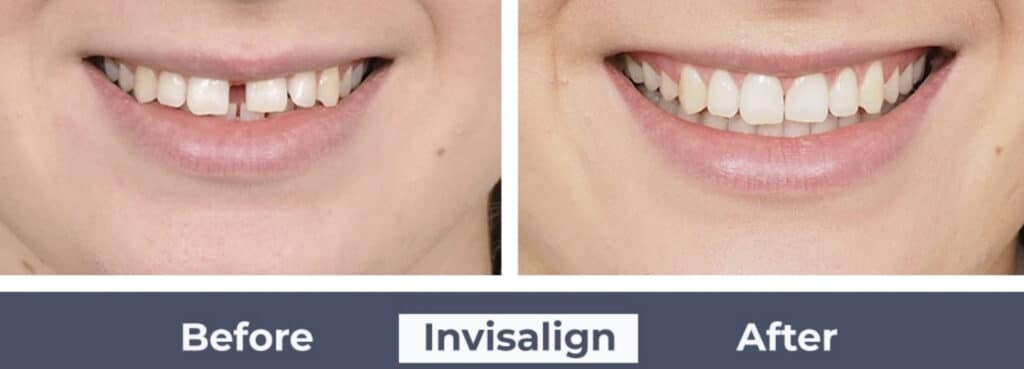 Side by side photos showing Fine Orthodontist Sydney before and after Invisalign.