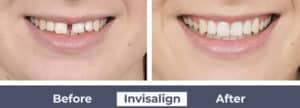 Side by side photos showing Fine Orthodontist Sydney before and after Invisalign.