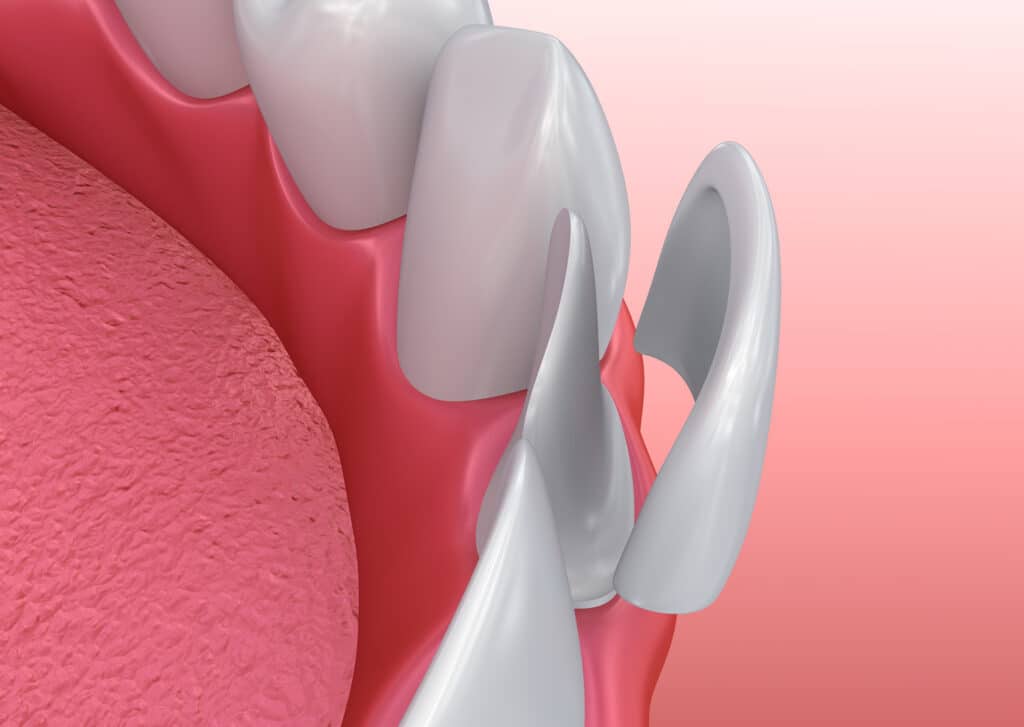 Dental Veneers: Porcelain Veneer installation Procedure. 3D illustration.