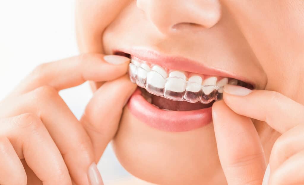 Woman putting in a clear aligner for orthodontic tooth straightening while smiling.