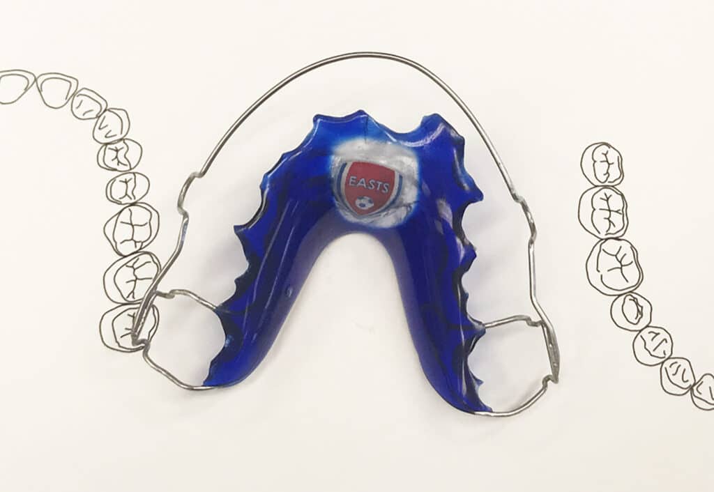 Blue orthodontic plate for tooth straightening.