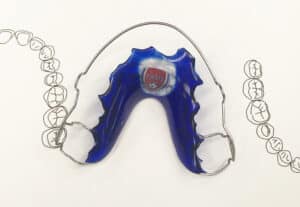 Blue orthodontic plate for tooth straightening.