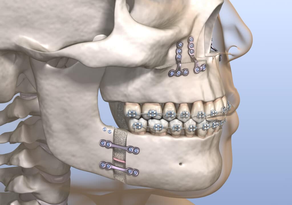 Corrective jaw surgery 3D illustration showing surgical movements and metal plates along with braces.