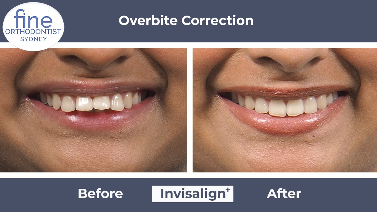 Invisalign Before And After Overbite Invisalign Before & After Photos