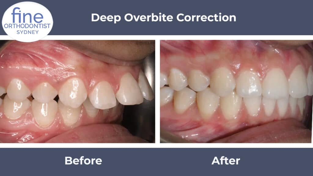 Deep overbite correction, before and after images side by side.