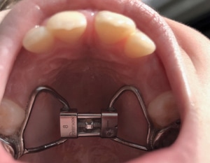 Palate expander shown in the roof of the mouth.