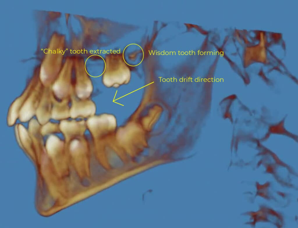 X-ray showing a case study of treatment at Fine Orthodontist Sydney.