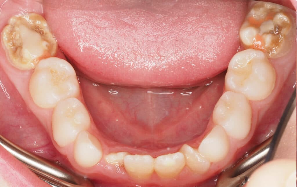 Chalky molars shown in photo of lower teeth (close up).