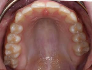 Upper teeth after treatment with spark aligners.